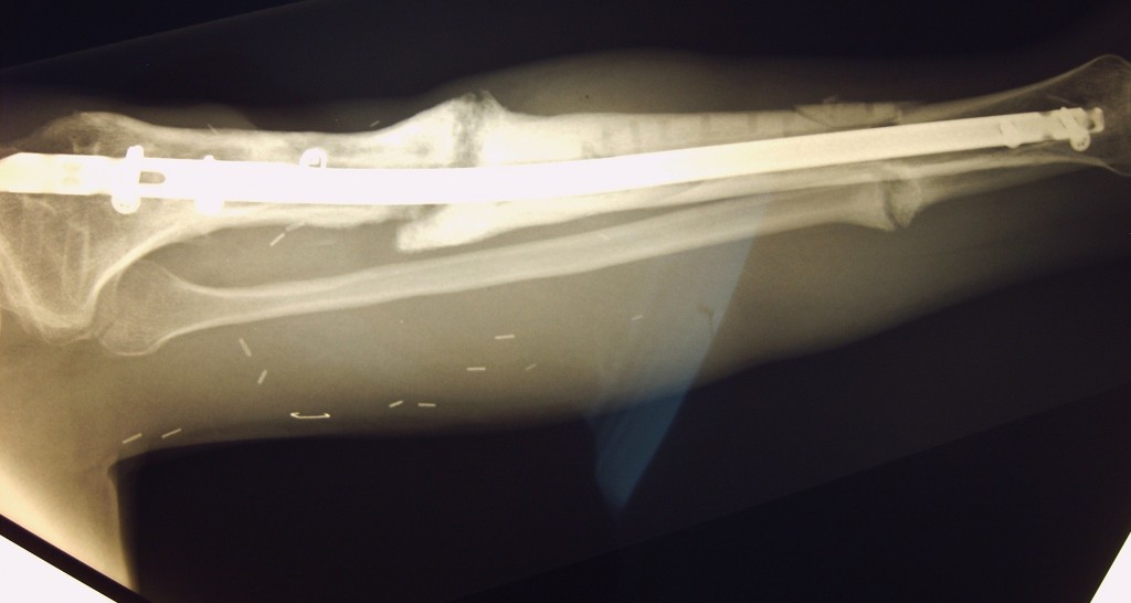 Jeff's bone grafting/rod replacement surgery